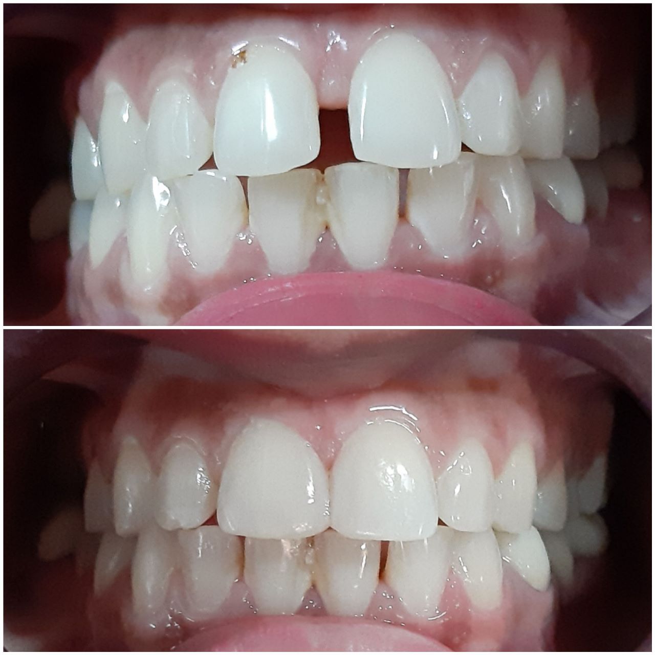 Teeth Whitening in Yamunanagar
