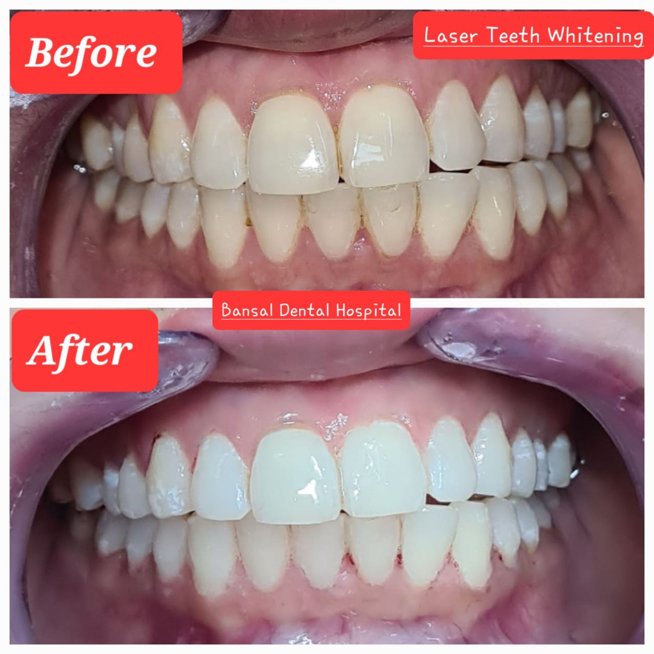 Fix Teeth in Ambala