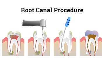 Single Sitting Root Canal Treatment in Haryana